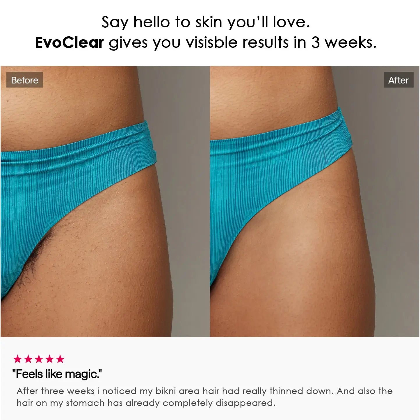 EvoClear™ - #1 FDA Approved Permanent Hair Removal Device